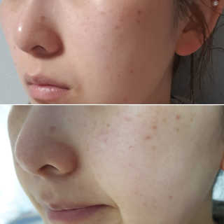 비알티씨 더 퍼스트 앰플 에센스 — 1점을 준 리뷰어가 2019년 4월 올린 사용 사진