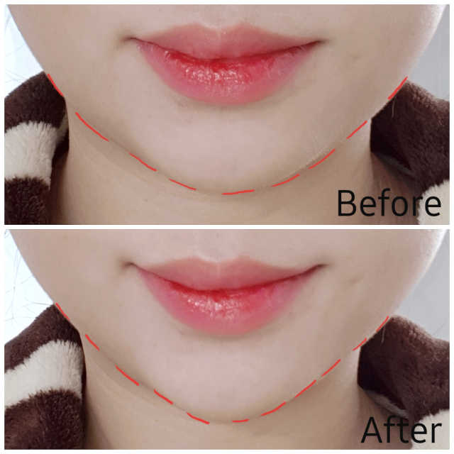 클루덤 리프팅 패치 리뷰 사진