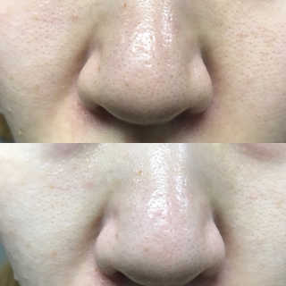 미팩토리 3단 흑돼지코팩 3매입 X 2 — 5점을 준 리뷰어가 2018년 10월 올린 사용 사진