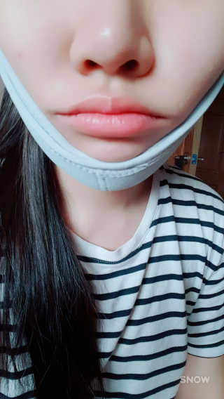 메디미 브이미 업 2스텝 브이라인벨트 — 3.5점을 준 리뷰어가 2017년 6월 올린 사용 사진