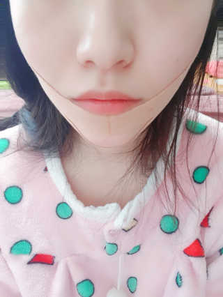 아이디플라코스메틱 아이디 페이스핏 마이너스 밴드 — 5점을 준 리뷰어가 2019년 10월 올린 사용 사진