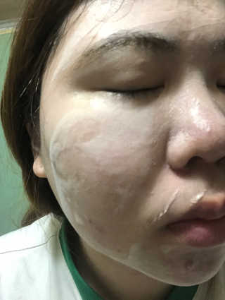 셀퓨전씨 트리악 포어 딜리트 버블 팩 — 5점을 준 리뷰어가 2018년 4월 올린 사용 사진