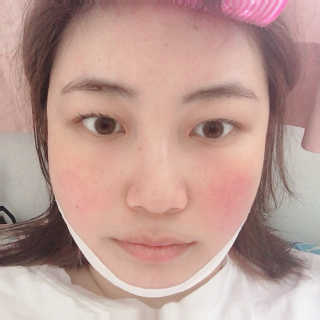 스케덤 클루덤 리프팅 패치 — 5점을 준 리뷰어가 2019년 4월 올린 사용 사진