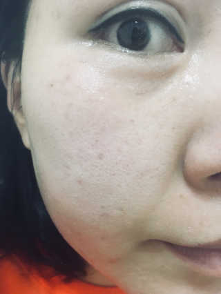 아이소이 불가리안 로즈 블레미쉬 케어 스팟_잡티스팟 — 5점을 준 리뷰어가 2018년 4월 올린 사용 사진