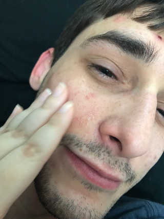 2018 아이소이 잡티세럼 리미티드 컬렉션 — 3.83점을 준 리뷰어가 2017년 5월 올린 사용 사진
