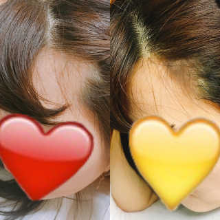 다슈코리아 다슈 데일리 헤어라인 커버 쿠션 — 3.33점을 준 리뷰어가 2017년 5월 올린 사용 사진