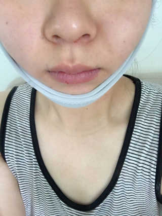 메디미 브이미 업 2스텝 브이라인벨트 — 4.5점을 준 리뷰어가 2017년 6월 올린 사용 사진