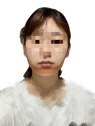 아이디플라코스메틱 아이디 페이스핏 마이너스 밴드 — 5점을 준 리뷰어가 2020년 4월 올린 사용 사진