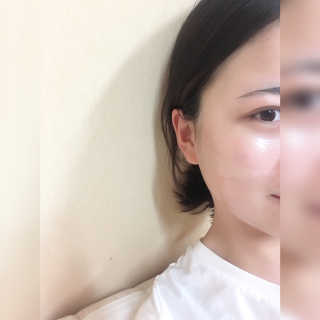 [더마허브] 주사팩 5종, 물광,백옥,태반,신데렐라 등 — 4.5점을 준 리뷰어가 2018년 3월 올린 사용 사진