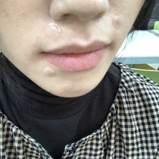 캐치미패치 트러블 스팟패치 — 5점을 준 리뷰어가 2020년 1월 올린 사용 사진