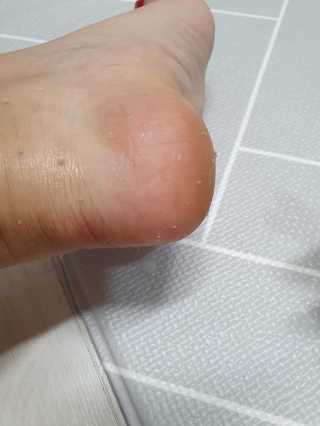 클린앤블락 클린풋 각질 솔루션 — 5점을 준 리뷰어가 2019년 7월 올린 사용 사진
