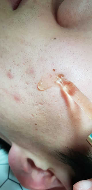 그리니프 얼티밋블레미쉬 솔루션 앰플 30ml — 4.67점을 준 리뷰어가 2019년 1월 올린 사용 사진