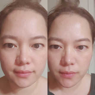 아이디플라코스메틱 아이디 페이스핏 플러스 패치 — 3.5점을 준 리뷰어가 2019년 10월 올린 사용 사진