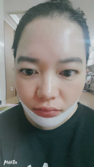 스케덤 클루덤 리프팅 패치 — 4.5점을 준 리뷰어가 2019년 3월 올린 사용 사진