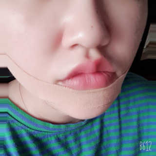 아이디플라코스메틱 아이디 페이스핏 마이너스 밴드 — 5점을 준 리뷰어가 2019년 9월 올린 사용 사진