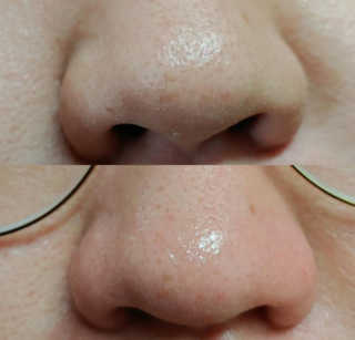 [메디필]엑스트라 슈퍼9 250ml+화장솜40ea — 5점을 준 리뷰어가 2020년 3월 올린 사용 사진