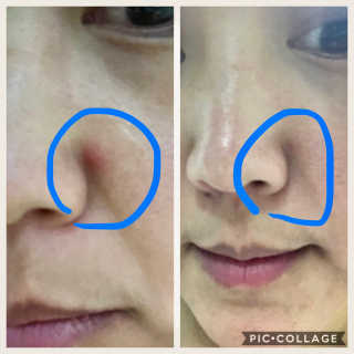 아이소이 파란소화기 응급스팟 — 3.67점을 준 리뷰어가 2018년 3월 올린 사용 사진