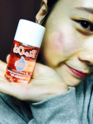 Bio-oil(바이오오일) 바이오오일(Bio-oil) — 3.5점을 준 리뷰어가 2017년 2월 올린 사용 사진