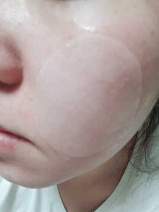 자이엘 S.O.S 레드 칙 케어팩 2 Box — 5점을 준 리뷰어가 2019년 11월 올린 사용 사진
