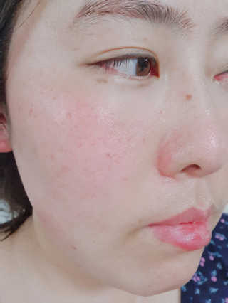 NDR 엔디알 엔디알 피토 에이 앰플 — 5점을 준 리뷰어가 2020년 1월 올린 사용 사진