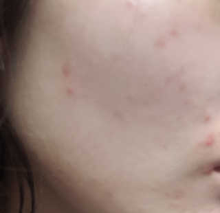 보타니티 [홍]조[진]정[결]케어 플라본 세럼 — 2.67점을 준 리뷰어가 2018년 5월 올린 사용 사진