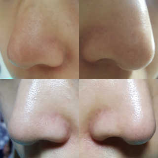 나이팅게일 TAKO PACK NOSE [문어코팩] — 5점을 준 리뷰어가 2018년 5월 올린 사용 사진