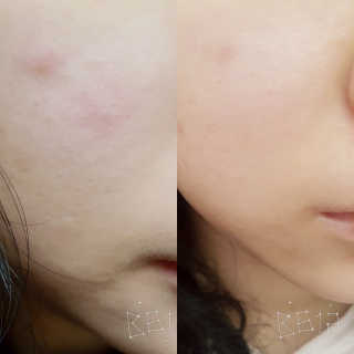 아이소이 파란소화기 응급스팟 — 5점을 준 리뷰어가 2018년 3월 올린 사용 사진