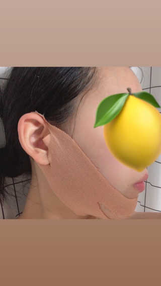 아이디플라코스메틱 아이디 페이스핏 마이너스 밴드 — 5점을 준 리뷰어가 2019년 9월 올린 사용 사진