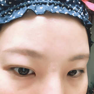캐치미패치 트러블 스팟패치 — 5점을 준 리뷰어가 2020년 1월 올린 사용 사진