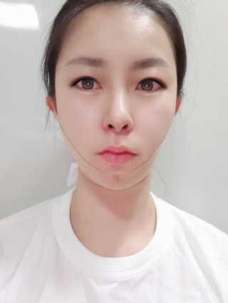 아이디플라코스메틱 아이디 페이스핏 마이너스 밴드 — 5점을 준 리뷰어가 2019년 11월 올린 사용 사진