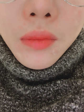 캐치미패치 트러블 스팟패치 — 5점을 준 리뷰어가 2019년 12월 올린 사용 사진