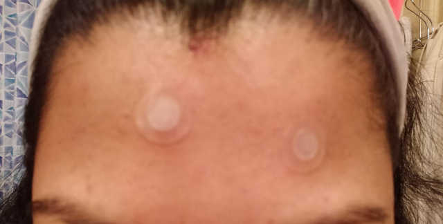 2 단계 스팟 케어 여드름 패치 리뷰 사진
