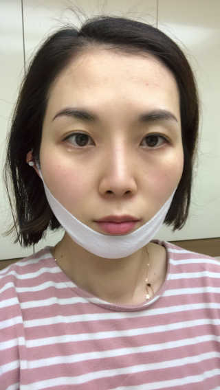스케덤 클루덤 리프팅 패치 — 4.5점을 준 리뷰어가 2019년 3월 올린 사용 사진