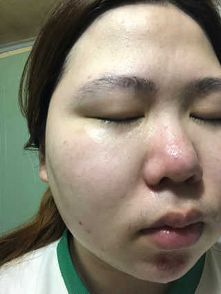 셀퓨전씨 트리악 포어 딜리트 버블 팩 — 5점을 준 리뷰어가 2018년 4월 올린 사용 사진