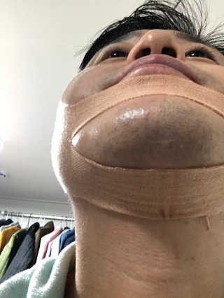 아이디플라코스메틱 아이디 페이스핏 마이너스 밴드 — 4점을 준 리뷰어가 2020년 1월 올린 사용 사진