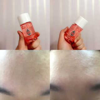 Bio-oil(바이오오일) 바이오오일(Bio-oil) — 4점을 준 리뷰어가 2017년 1월 올린 사용 사진