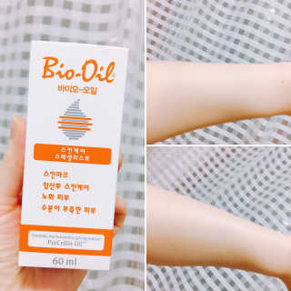 Bio-oil(바이오오일) 바이오오일 — 3.5점을 준 리뷰어가 2016년 10월 올린 사용 사진