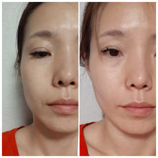 아이디플라코스메틱 아이디 페이스핏 마이너스 밴드 — 4점을 준 리뷰어가 2019년 9월 올린 사용 사진