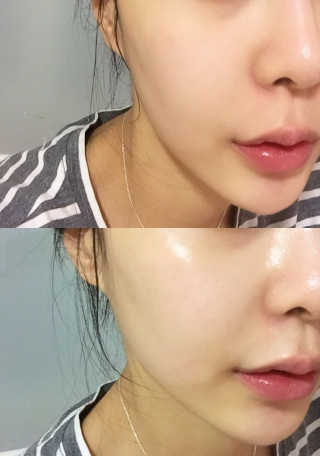 Bio-oil(바이오오일) 바이오오일 — 4점을 준 리뷰어가 2016년 10월 올린 사용 사진