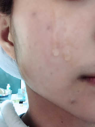 그리니프 얼티밋블레미쉬 솔루션 앰플 30ml — 4점을 준 리뷰어가 2019년 1월 올린 사용 사진