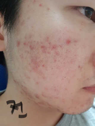 라포랩 laforlab 라포랩 센텔라스카 연고(바질) — 2.5점을 준 리뷰어가 2017년 12월 올린 사용 사진