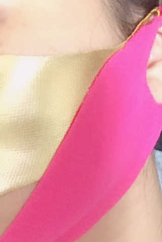 [스케덤] 상악밴드 — 2점을 준 리뷰어가 2019년 6월 올린 사용 사진