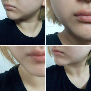 메디미 브이미 업 2스텝 브이라인벨트 — 4.17점을 준 리뷰어가 2017년 9월 올린 사용 사진