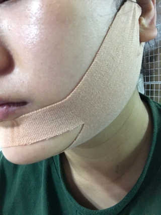 아이디플라코스메틱 아이디 페이스핏 마이너스 밴드 — 3점을 준 리뷰어가 2019년 11월 올린 사용 사진