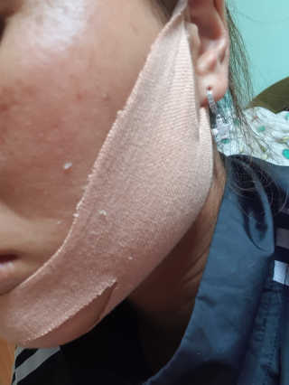 아이디플라코스메틱 아이디 페이스핏 마이너스 밴드 — 1점을 준 리뷰어가 2019년 11월 올린 사용 사진