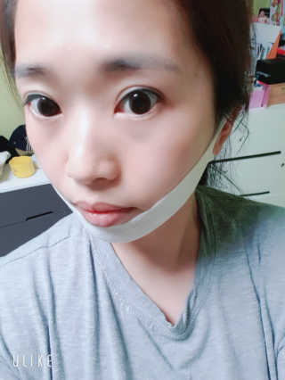 스케덤 클루덤 리프팅 패치 — 3.5점을 준 리뷰어가 2019년 4월 올린 사용 사진