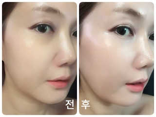 메디페르루테인앰플 3종 — 5점을 준 리뷰어가 2019년 8월 올린 사용 사진