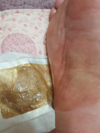 메디테라피 더마 릴렉스 힐링패치 — 4점을 준 리뷰어가 2018년 4월 올린 사용 사진