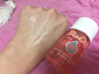 Bio-oil(바이오오일) 바이오오일(Bio-oil) — 4점을 준 리뷰어가 2017년 2월 올린 사용 사진