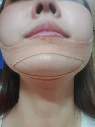 아이디플라코스메틱 아이디 페이스핏 마이너스 밴드 — 5점을 준 리뷰어가 2019년 10월 올린 사용 사진